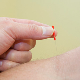 Acupuncture